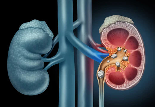 Kidney Stones – Risk Factors, Symptoms, Tips