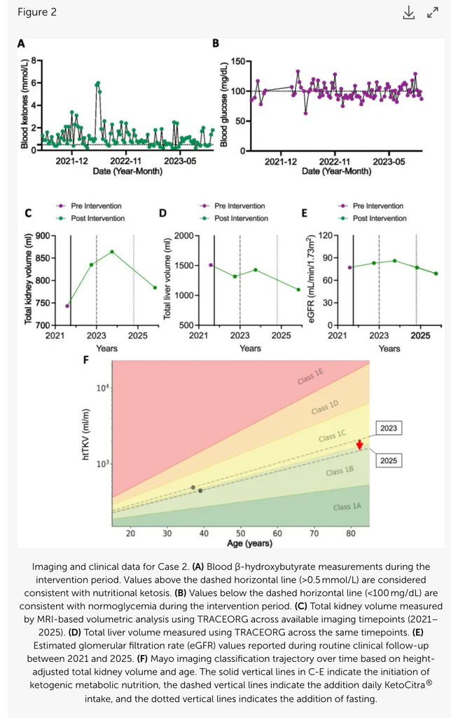 Halting Cyst Progression in ADPKD Using Long-term Ketogenic Metabolic Therapy and Supplementation with Exogenous Ketones and Alkaline Citrate—a Case Series